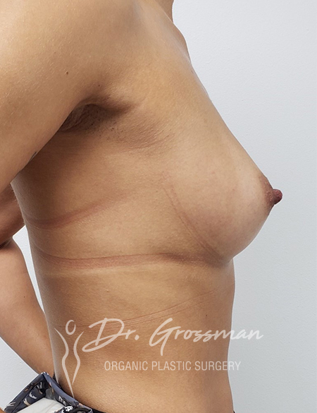 breast-augmentation-one